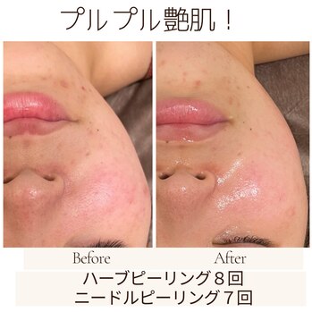 マイクロニードルピーリング | 京都舞鶴の複合美容サロンLuxtz(ラグズ